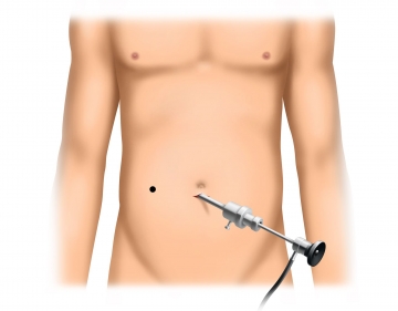 Initiation of pneumoperitoneum and inspection of the abdominal cavity