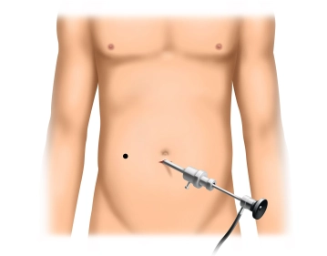 Initiation of pneumoperitoneum and inspection of the abdominal cavity