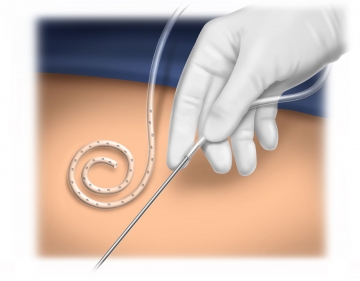 Threading the catheter