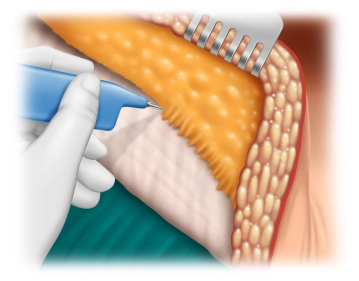 Detachment of the subcutis