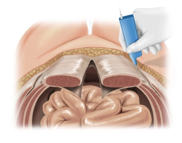 Incision of the aponeurosis of the external oblique muscle