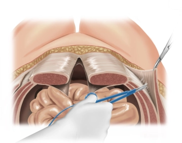 Separation of the external oblique muscle