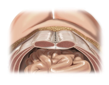 Closure of the anterior layer of the rectus sheath
