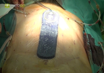 Application of Wound VAC