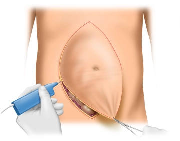 Skin incision; excision of the scar