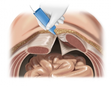 Freeing the posterior rectus sheath/peritoneum