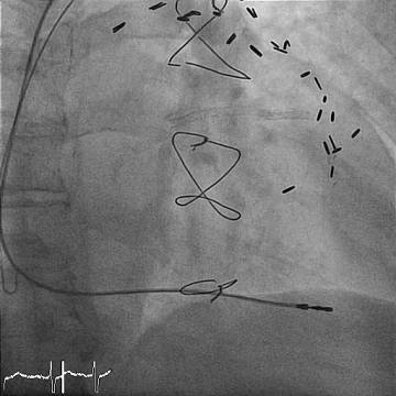 Colocación del electrodo ventricular