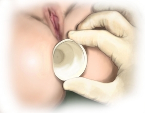 Verifying the indication and dilating the anal sphincter
