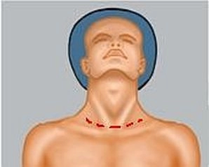 Prevention and management of intraoperative complications