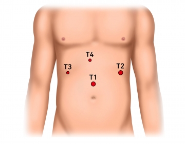 Establishing the pneumoperitoneum, inserting the trocar for laparoscope and exploring the upper quadrants