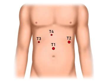 Establishing the pneumoperitoneum, inserting the trocar for laparoscope and exploring the upper quadrants