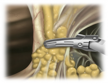 Inserting the working trocars, transecting the round and falciform ligaments of the liver