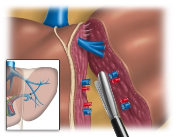Starting parenchymal resection, transecting the portal vein and hepatic artery