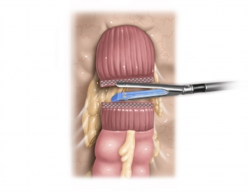 Dividing the upper rectum 