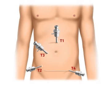 Pneumoperitoneum and trocar positioning