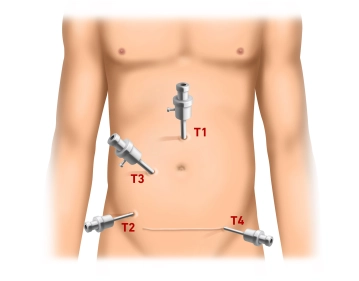 Pneumoperitoneum and trocar positioning
