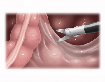 Opening the right pelvic peritoneum