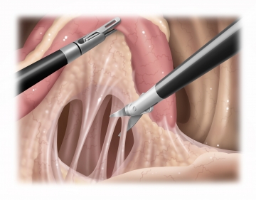 Mobilizing the posterior rectum