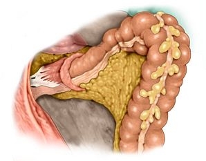 Mobilizing the rectum laterally and anteriorly