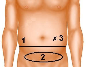 Exposing the posterior rectus sheath lamina and dividing the peritoneum