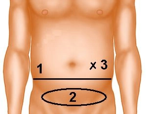 Exposing the posterior rectus sheath lamina and dividing the peritoneum