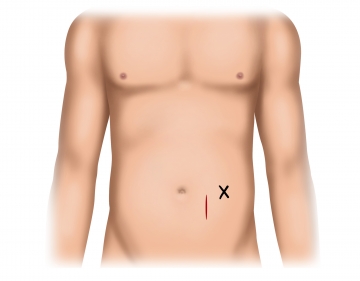 Incising the pararectal skin and exposing the anterior rectus sheath lamina