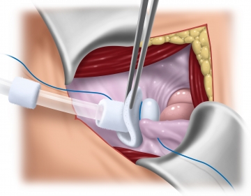 Placing the dialysis catheter and closing the peritoneum