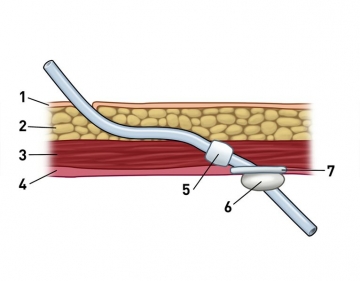 Exiting the dialysis catheter