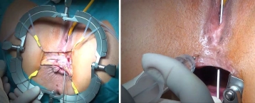 Special instruments and fixation systems