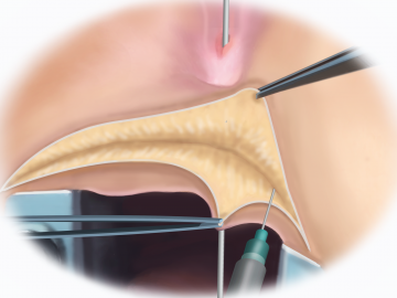 Probing the fistula, saline injection and transverse perineal incision