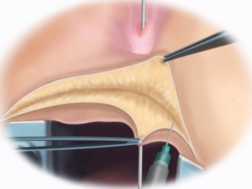 Probing the fistula, saline injection and transverse perineal incision