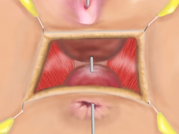 Dissecting the rectovaginal space and exposing the external sphincter and puborectalis