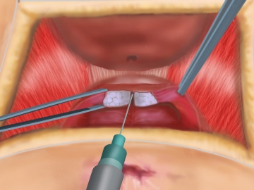 Dissecting the sphincter stumps