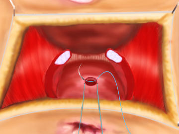 Excising the rectal fistula opening and suturing