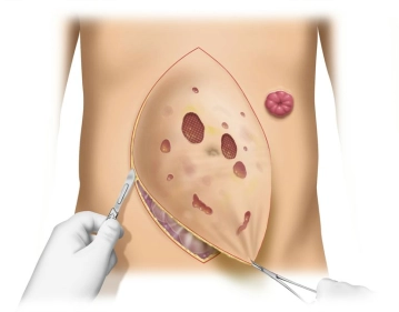 Preparation of the Hernia Sac and Exposure of the Hernia Defect