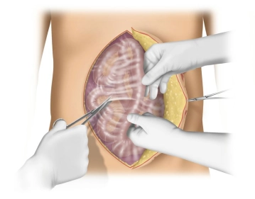 Intra-abdominal Adhesiolysis