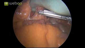 Ligadura radical de la A. mesentérica inferior