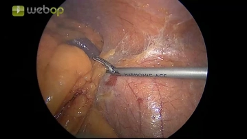 Movilización del colon descendente desde lateral