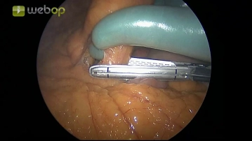Sección de la V. mesentérica inferior