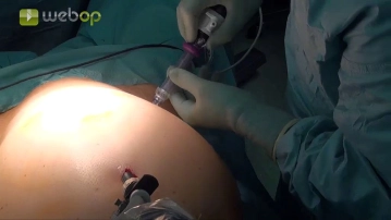 Colocación del 1.º trocar de trabajo