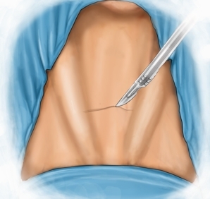 Skin incision