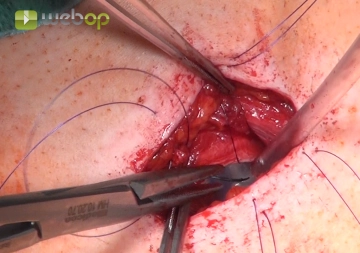 Transcutaneous fixation of the fenestration