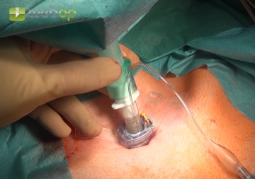 Inserting and connecting the tracheostomy tube