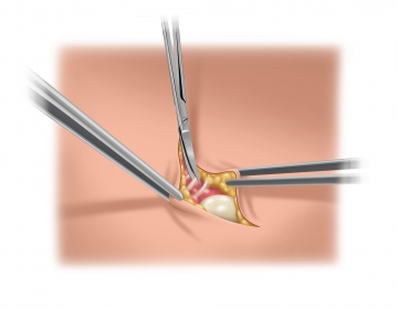 Dissecting the hernia sac