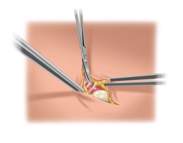 Dissecting the hernia sac