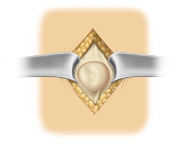 Exposing the fascial margins 360°