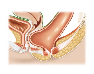 Diagnostic assessment; dissecting an anterior mucosal flap