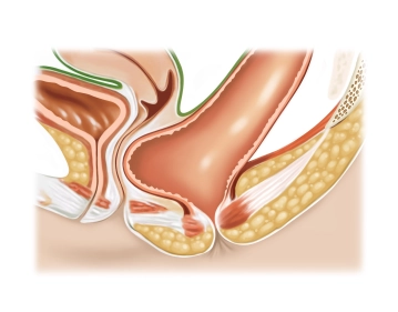 Diagnostic assessment; dissecting an anterior mucosal flap