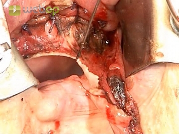 Resecting the mucosa