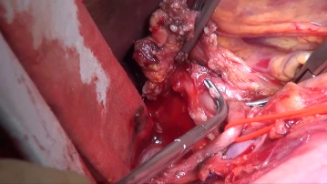 Lymphadenectomy III (celiac trunk/station 9)
